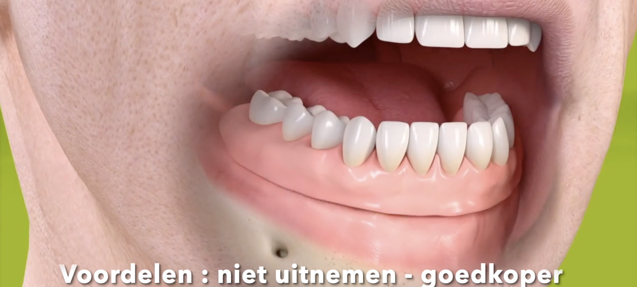 Hybride-brug-op-implants.mp4