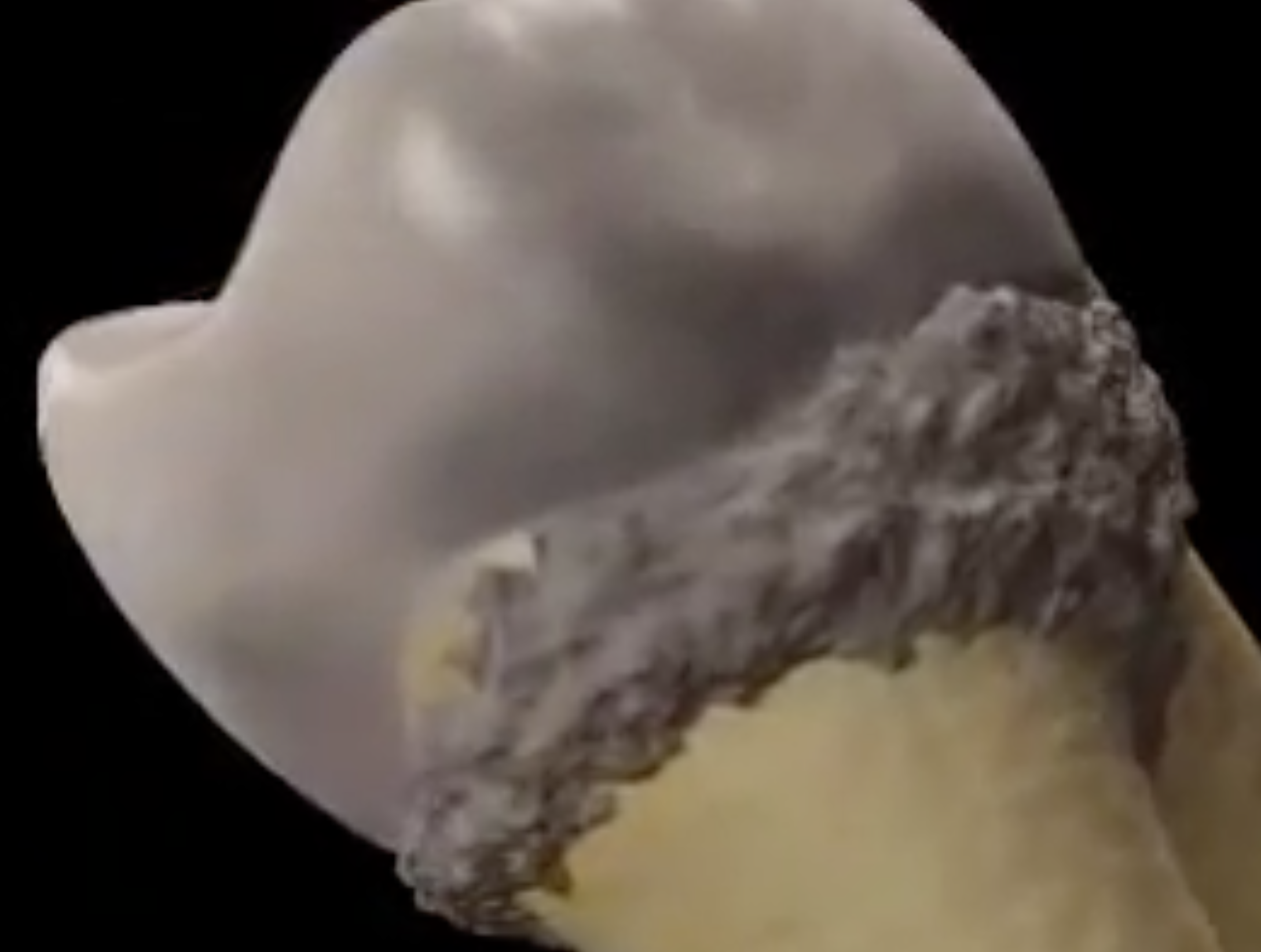 periodontitis.mp4