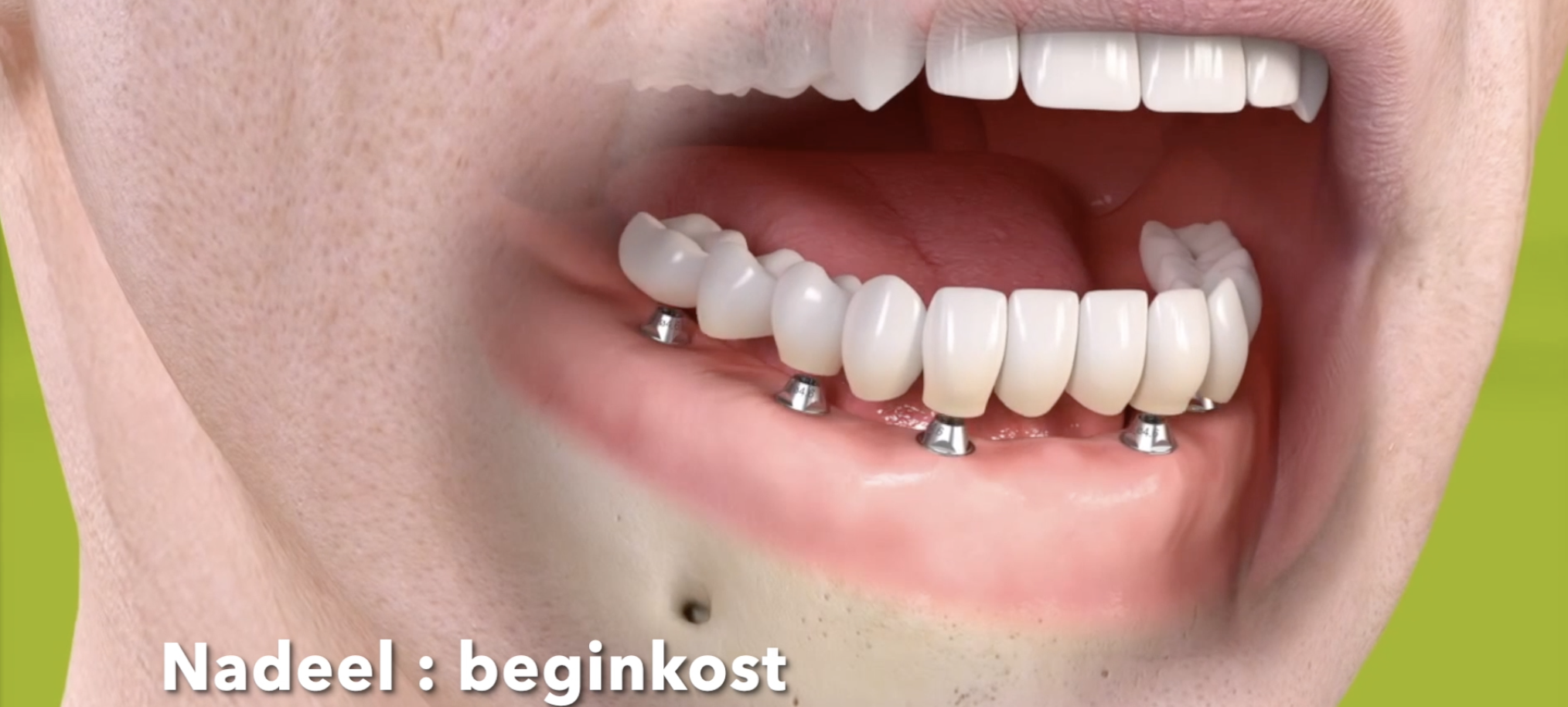 Vaste-brug-op-implants.mp4