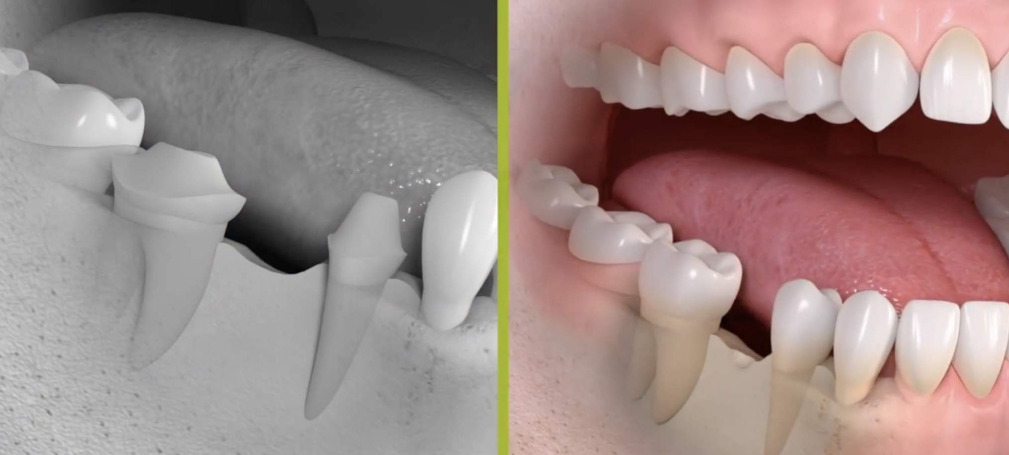1-tand-brug-versus-implant.mp4